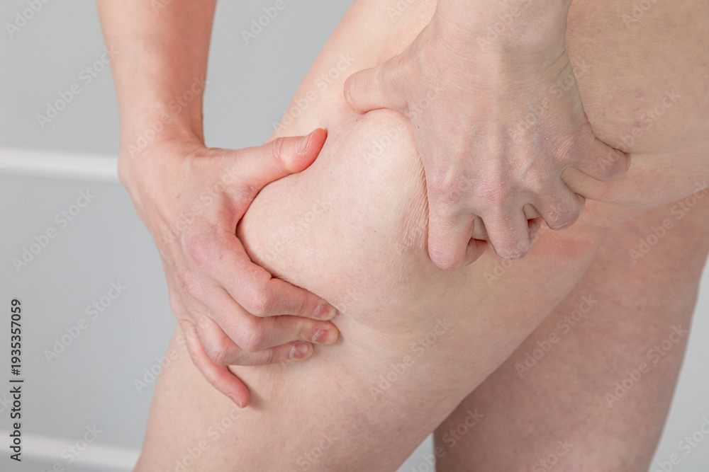 Ταπετσαρία Woman pinching her thigh skin to show cellulite