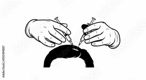 Surgical hands performing hair transplant with needles on a black scalp