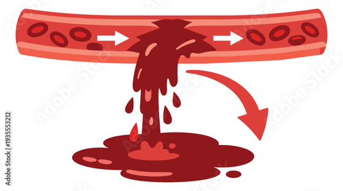 Graphic illustration of a blood vessel depicting a hemorrhage and blood cells flowing for medical concepts