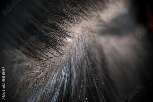 Wallpaper Mural Visualizing scalp problems, white crusts and dry dandruff flakes in the hair Torontodigital.ca