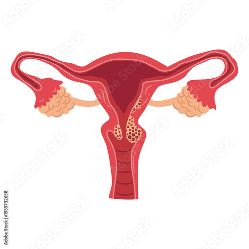 Photos Simplified illustration displays internal reproductive organs affected by growth