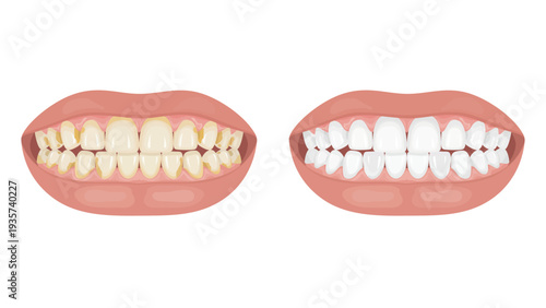Teeth whitening before and after comparison vector