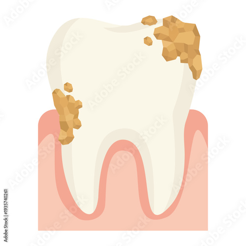 Tooth with heavy dental calculus illustration