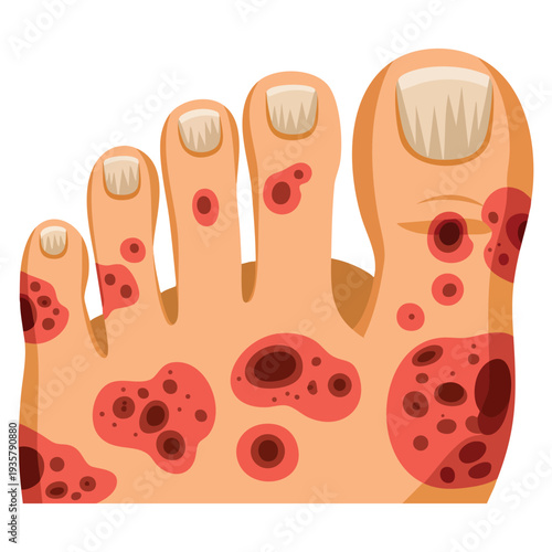 Foot dermatitis athlete foot disease dermatological problems vector illustration showing skin irritation infection and medical condition concept