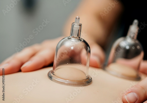 Anti-Cellulite Vacuum Cupping Massage at Spa – Lymphatic Drainage Body Contouring Treatment Closeup