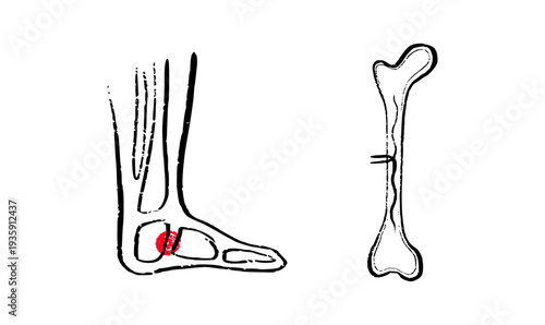 Osteomyelitis disease sketch