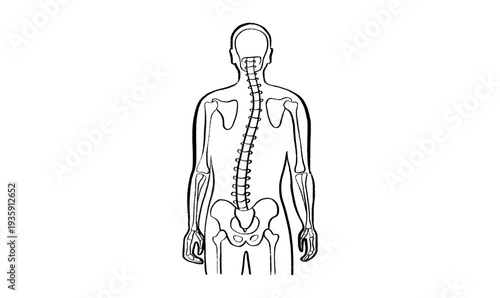 Scoliosis spine deformity