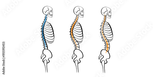 Scoliosis spine deformity
