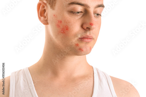 Teenage boy with acne on wh...