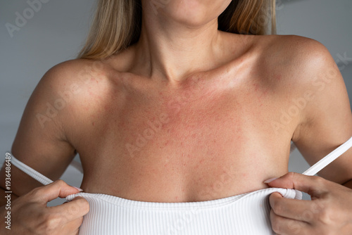 Obraz na plátně Female chest with sunburn redness and allergic rash after sun exposure