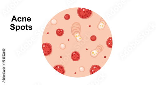 Acne Spots Illustration - Skin Care, Acne Treatment, and Skin Health Concept