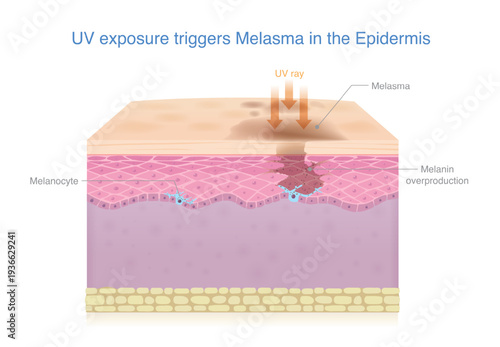UV rays affect to dark spots on the skin. Accumulation of pigment make melasma, dark spots, and hyperpigmentation on the skin surface. UV triggering melanocytes to produce excess melanin.