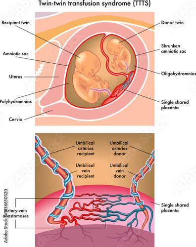 Medical illustration of Twin-twin transfusion syndrome (TTTS)