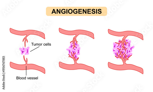 Angiogenesis in cancer tumor growth medical illustration. Cancer angiogenesis process with tumor cells. Vector for medical, education and science posters.