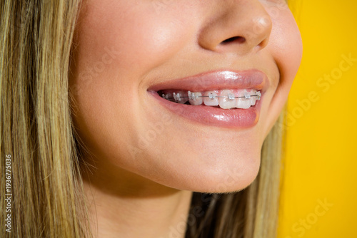 Fotografie Bright smile of a young woman with braces against a yellow backdrop
