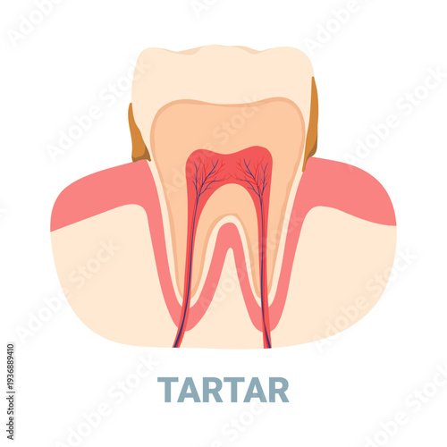 Detailed isolated diagram of a tooth with tartar buildup and internal structure for dental education vector illustration