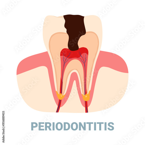 Isolated cross section showing periodontitis dental disease and infected tooth root vector illustration