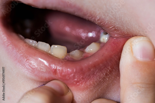 Quadro su tela Child mouth with visible eruption of permanent molar among primary teeth