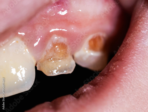 Quadro em tela Close-up of human oral cavity showing severe enamel hypoplasia and tooth decay d