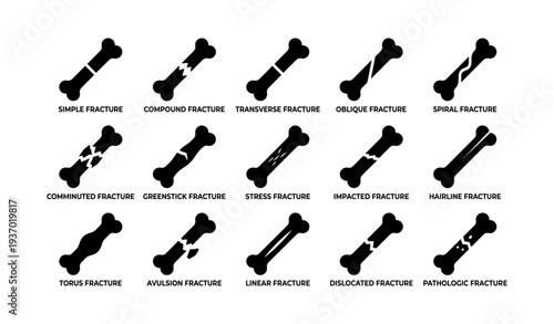 Types of bone fractures: simple, compound, transverse, oblique, spiral, comminuted, greenstick, stress, impacted, hairline, torus, avulsion, linear, dislocated, pathologic