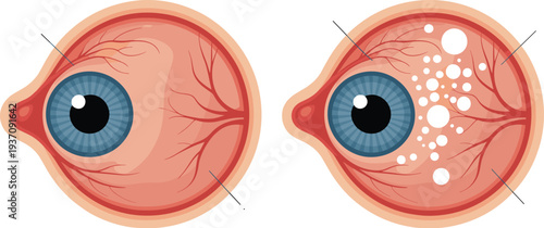 Eye anatomy comparison illustration showing healthy eye and retinal disease condition, ophthalmology medical diagram vector healthcare educational concept