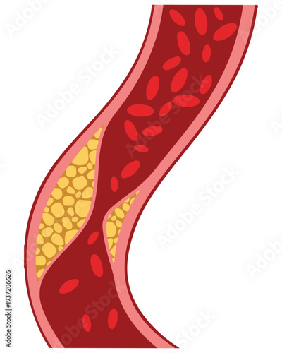 Artery Plaque Buildup