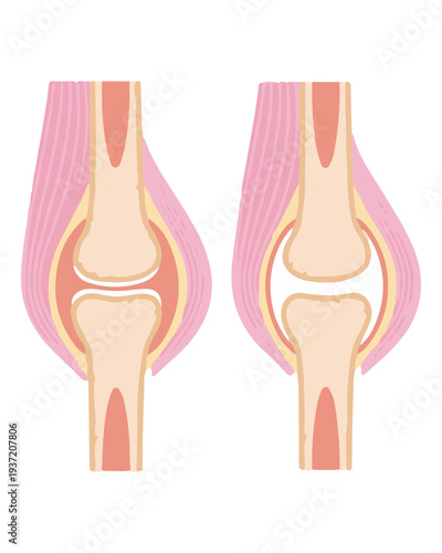 Healthy vs Arthritic Knee Joint