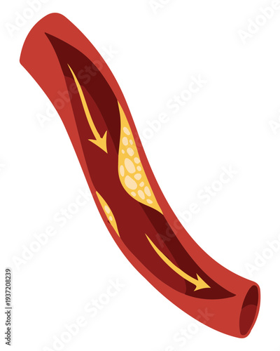 Artery with Atherosclerosis