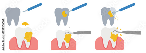 PLAQUE REMOVAL - Scraper tool cleaning a yellow spot off a molar  Flat Vector Illustration on Transparent Background