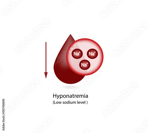 Hyponatremia, low plasma sodium level. Sodium Na excess and deficit electrolyte disorders, blood test tube, Scientific design. Vector illustration.