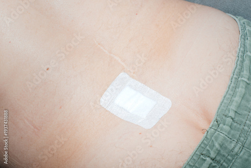 Post surgery scar with medical adhesive bandage