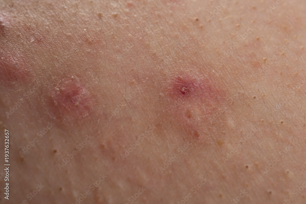 Fototapeta premium Acne on skin closeup photo. Irritated skin with pimples acne texture. Close up epidermis with inflamed follicles and acne. Detailed skin with acne.