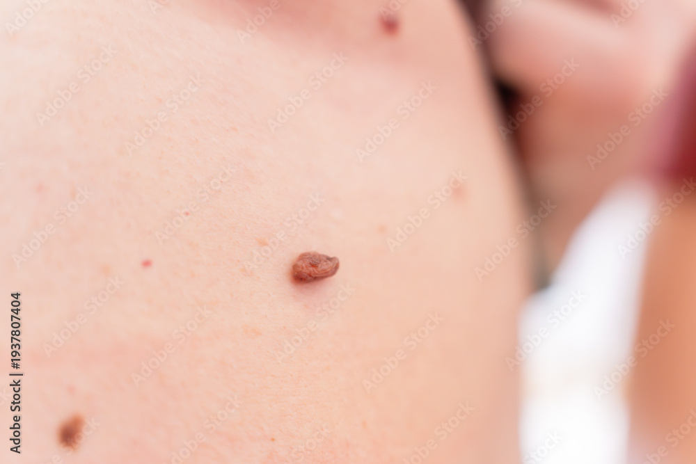 Fototapeta premium A mole on the body in close-up, the concept of dermatology