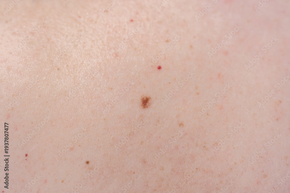 Fototapeta premium A mole on the body in close-up, the concept of dermatology