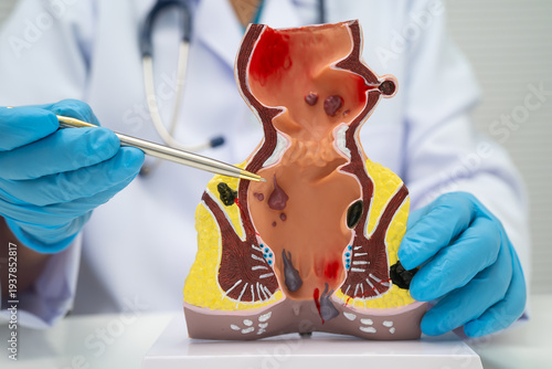 Schilderij op canvas Asian doctor with rectum and hemorrhoid human anatomy model at hospital, inflamed vascular structure