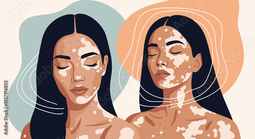 Two beautiful women with vitiligo skin condition are shown in a stylized portrait against an abstract background of flowing lines.