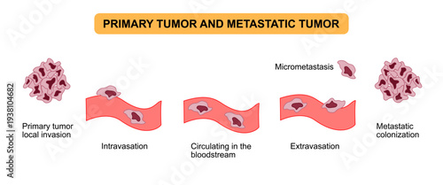 Primary tumor and metastatic tumor formation diagram. Tumor cell spread in bloodstream, Intravasation and Extravasation. Vector illustration for medical, science, posters and education.