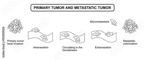 Primary tumor and metastatic tumor formation diagram. Tumor cell spread in bloodstream, Intravasation and Extravasation. Vector line drawing illustration for medical, science, posters and education.