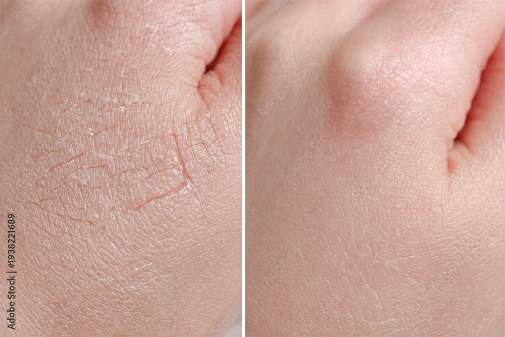 Fototapeta premium Before and after collage of dry cracked skin on hand being treated with moisturizing cream for healthy results