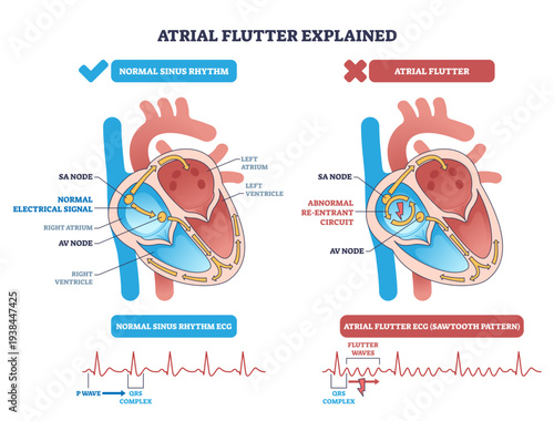Atrial flutter explained diagram contrasts normal rhythm with re-entrant circuit in the heart, highlighting SA node, AV node, and sawtooth ECG pattern for clarity, transparent background.