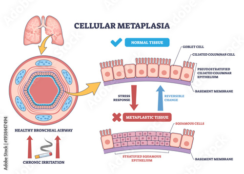 Cellular metaplasia illustrated, airway epithelium shifts from ciliated columnar to stratified squamous under stress, lungs, cilia, squamous cells highlighted, transparent background.