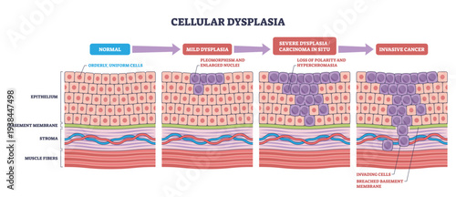 Cellular dysplasia diagram maps stages from normal epithelium to carcinoma in situ and invasive cancer, key elements, epithelial cells, nuclei, basement membrane, transparent background.