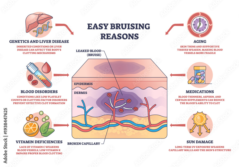 Fototapeta premium Easy bruising reasons diagram illustrates skin layers with broken capillary and leaked blood forming a bruise, key objects, skin cross-section, capillary, bruise, transparent background.