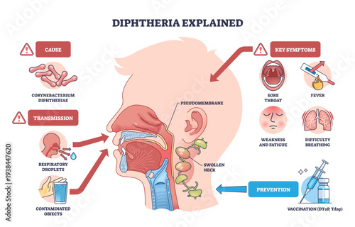 Diphtheria explained diagram showing infection path and symptoms, key focus on throat pseudomembrane, swollen neck nodes, and vaccine syringe for prevention, transparent background.