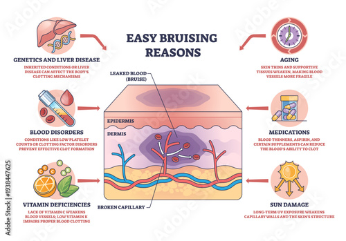 Easy bruising reasons diagram illustrates skin layers with broken capillary and leaked blood forming a bruise, key objects, skin cross-section, capillary, bruise, transparent background.