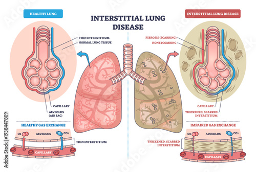 Interstitial lung disease outline contrasts healthy vs fibrotic lungs, showing alveoli thickening and impaired gas exchange, key objects, lungs, alveoli, capillaries, transparent background.