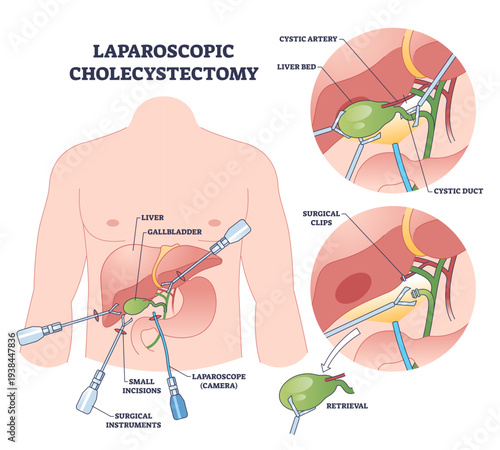 Laparoscopic cholecystectomy explained, instruments insert through small incisions to clip cystic duct and remove the gallbladder, highlights laparoscope, gallbladder, surgical clips.