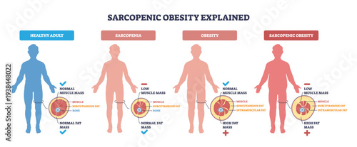 Sarcopenic obesity explained visually, four silhouettes compare muscle loss and fat gain, main objects are body silhouettes, fat-muscle cross-sections, and labels, transparent background.