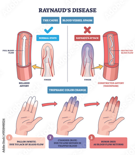 Raynauds phenomenon diagram shows finger artery spasm and triphasic hand color change, key objects, hand, finger, artery, transparent background.