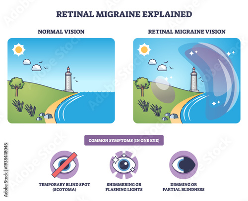Retinal migraine explained, simple visual comparing normal vs aura vision, showing lighthouse scene with scotoma and shimmering lights, highlighting eye symptoms, transparent background.